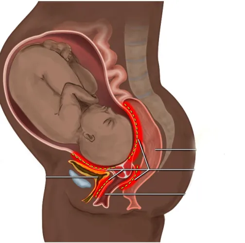 Obstetric fistula location diagram.