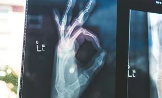 X-ray of hand in OK sign.