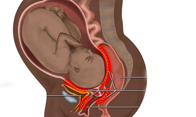 Obstetric fistula location diagram.