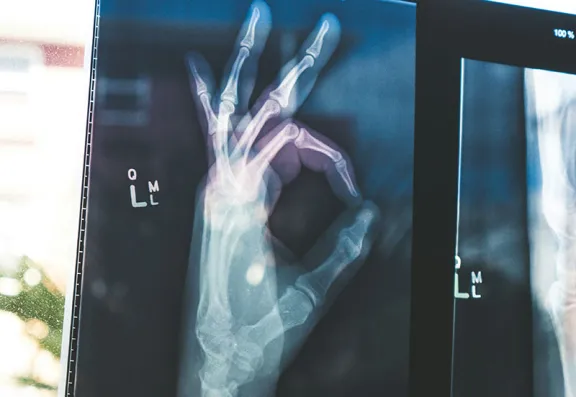 X-ray of hand in OK sign.